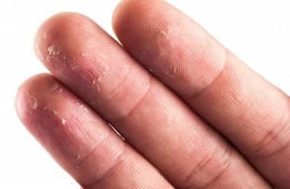 علت از بین رفتن اثر انگشت